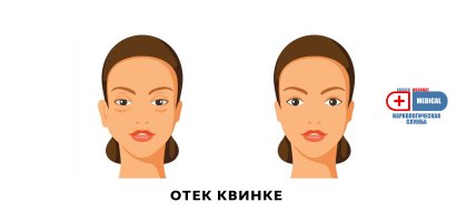 Отек Квинке.jpg Отек Квинке.jpg